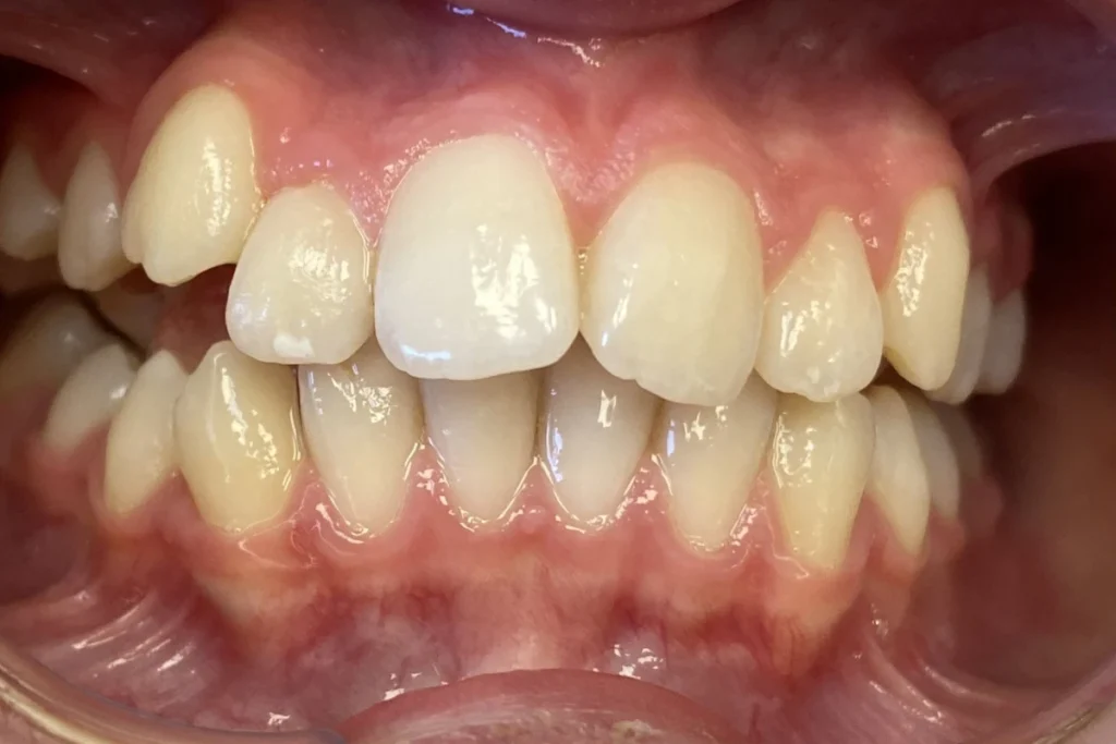 orthodontie adolescent trouillas 1 1