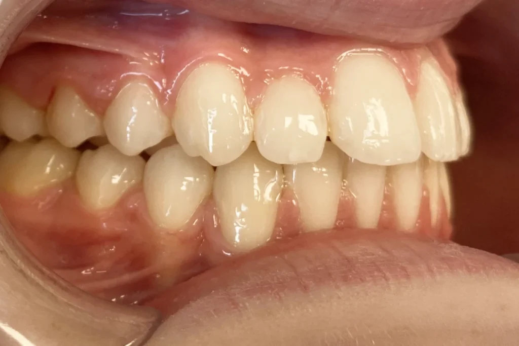 orthodontie adolescent trouillas 2 2