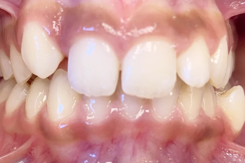 orthodontie adolescent trouillas 4 1