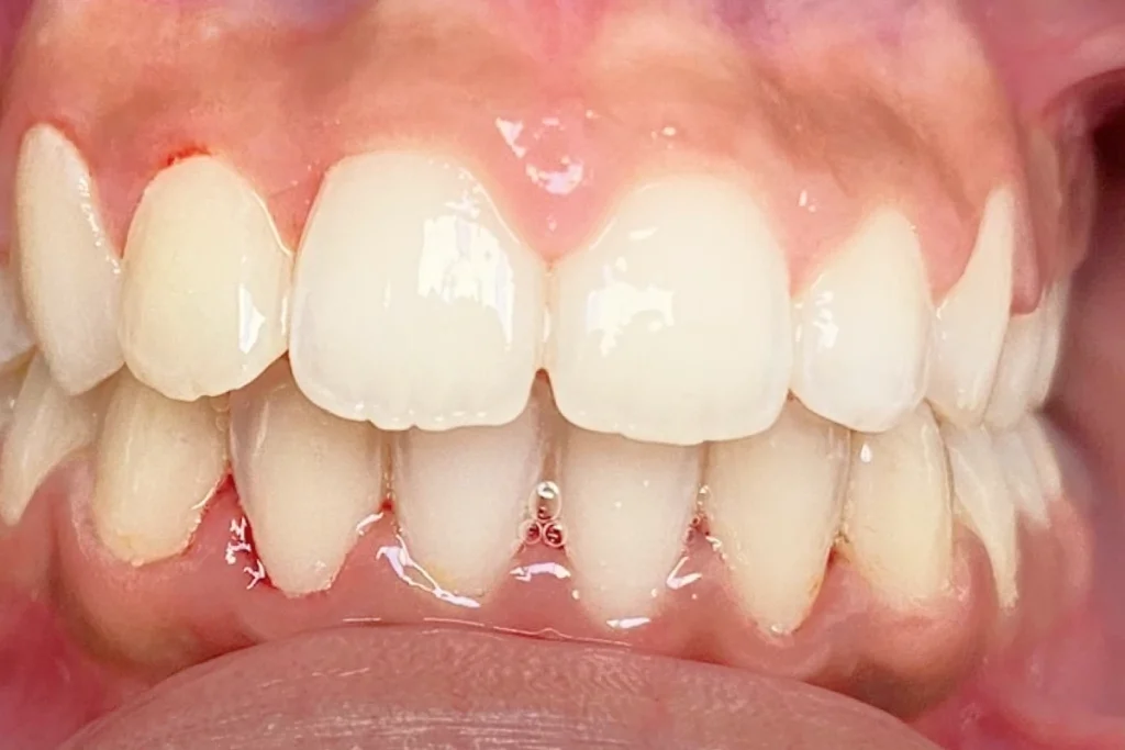 orthodontie adolescent trouillas 4 2