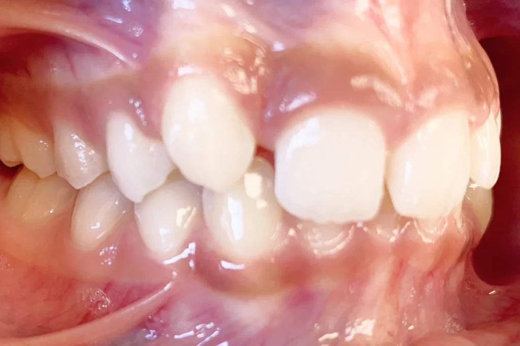orthodontie adolescent trouillas 4 3