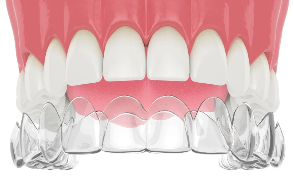 orthodontie aligneur invisible contention