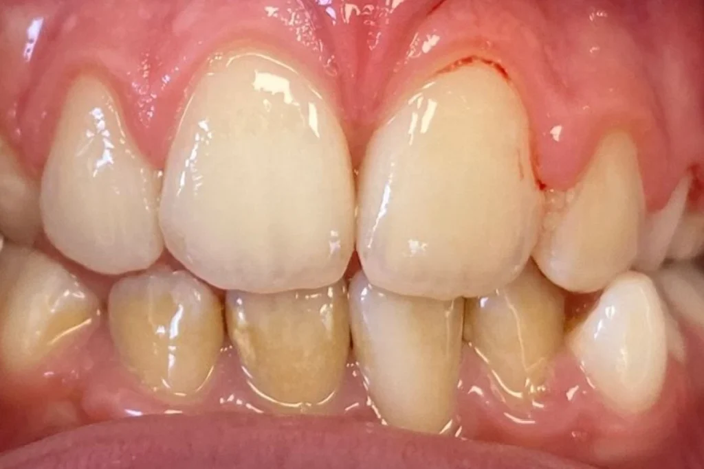 orthodontie enfant trouillas 2 2