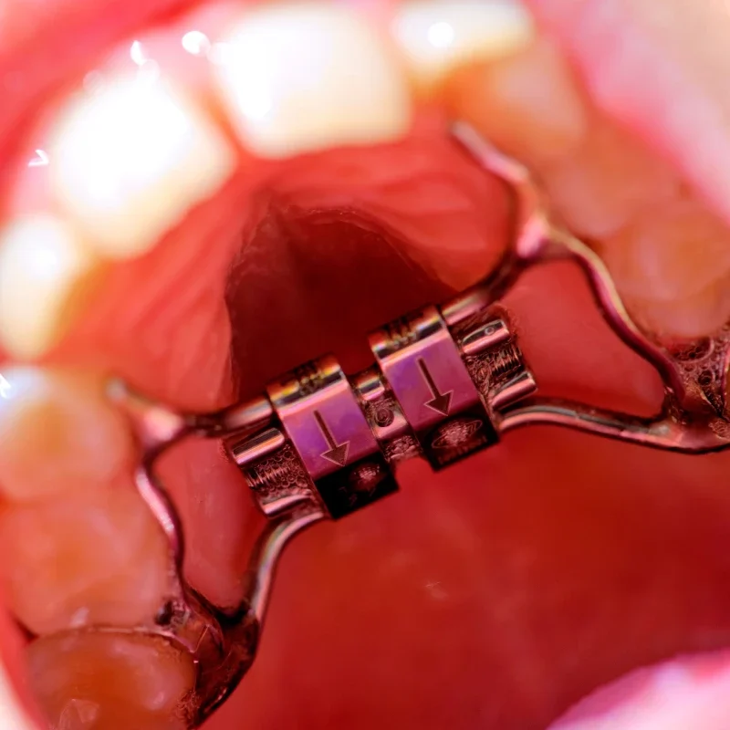 orthodontie enfant disjoncteur quad helix