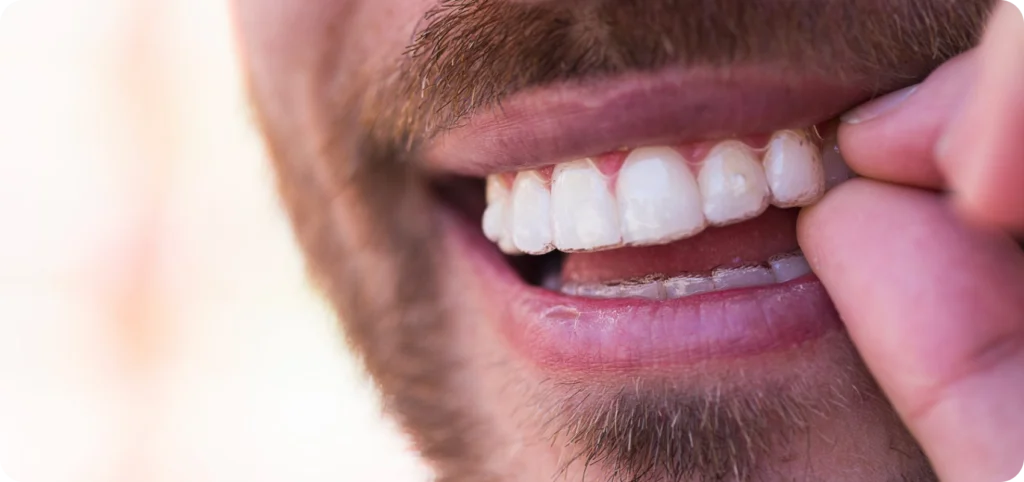 aligneurs invisibles perpignan