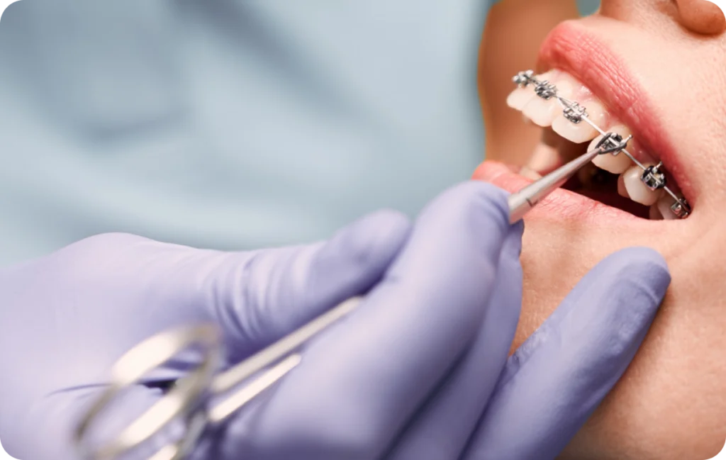 appareils dentaires perpipignan