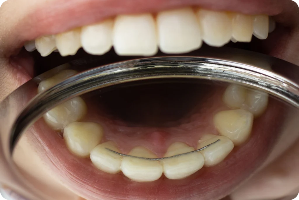 orthodontie contention thuir Dr Sophie CESARO - Dentiste à Trouillas orthodontie contention thuir