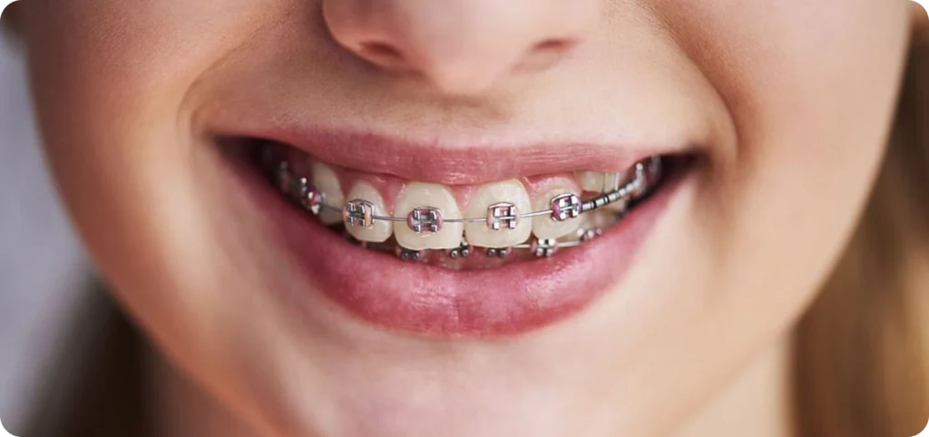 orthodontie multi bague prades Dr Sophie CESARO - Dentiste à Trouillas orthodontie multi bague prades