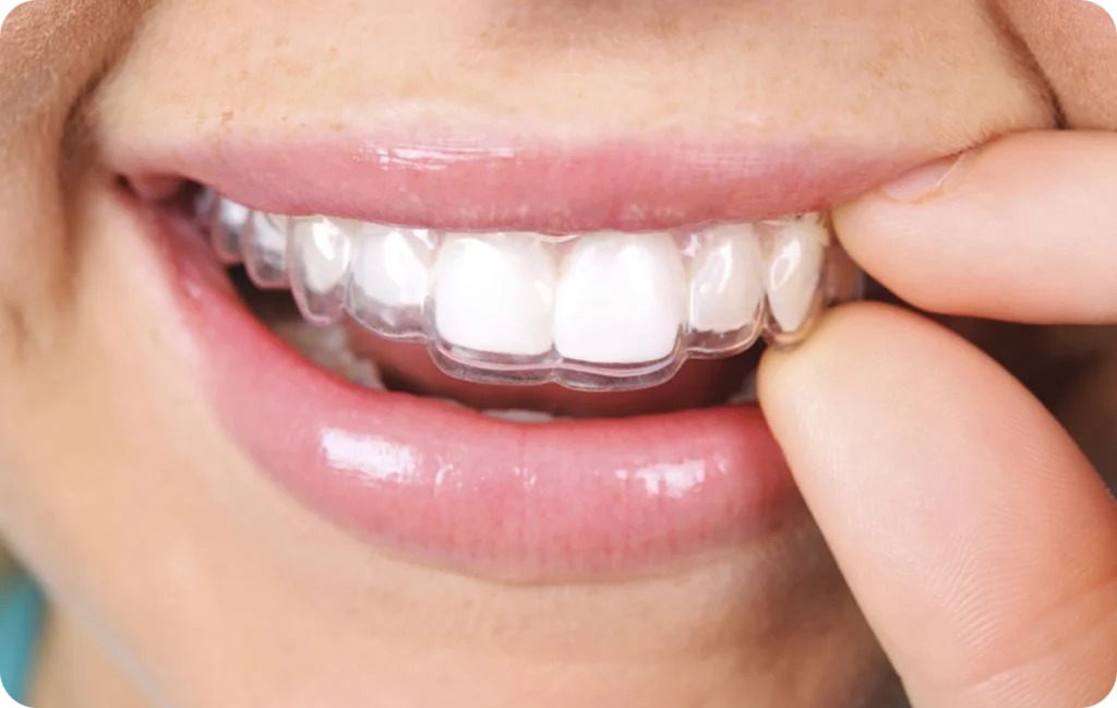 orthodontie perpipignan