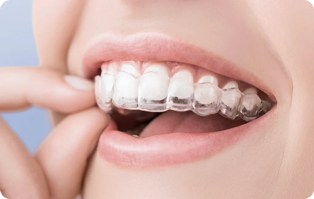 aligneursf prades consultation orthodontiste Dr Sophie CESARO - Dentiste à Trouillas aligneursf prades consultation orthodontiste