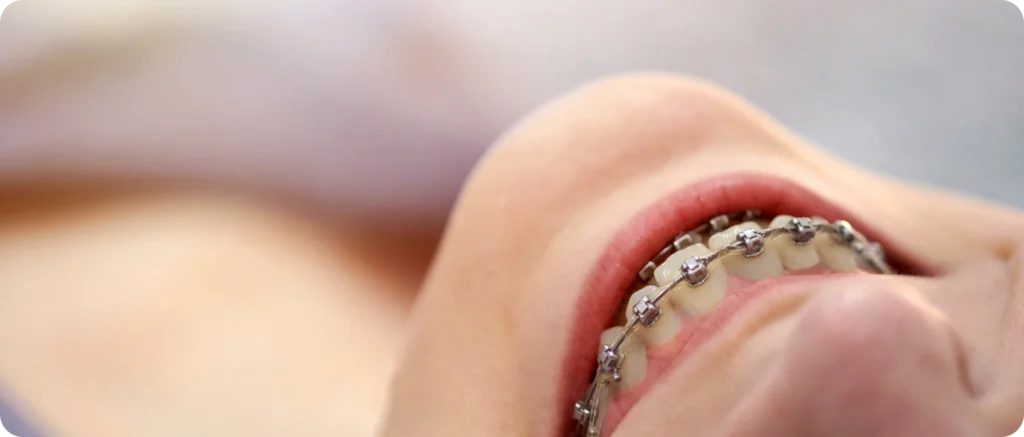 multi bagues prades consultation orthodontiste Dr Sophie CESARO - Dentiste à Trouillas multi bagues prades consultation orthodontiste