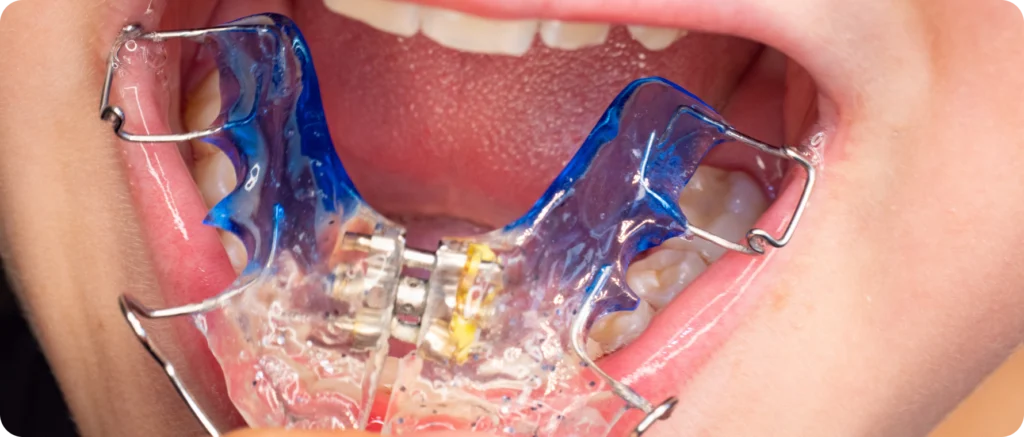 traitement interceptif prdes consultation orthodontiste Dr Sophie CESARO - Dentiste à Trouillas traitement interceptif prdes consultation orthodontiste